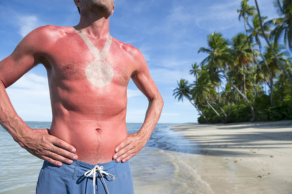 6 Worst Sunburns and How to Avoid Them
